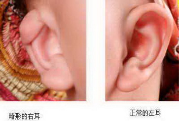 小耳畸形 小耳畸形是什么