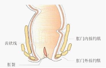 肛裂能自愈吗 三个原因告诉你不能