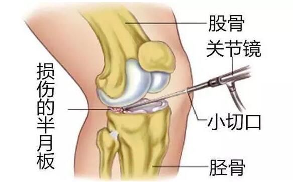 膝关节半月板损伤有哪些症状